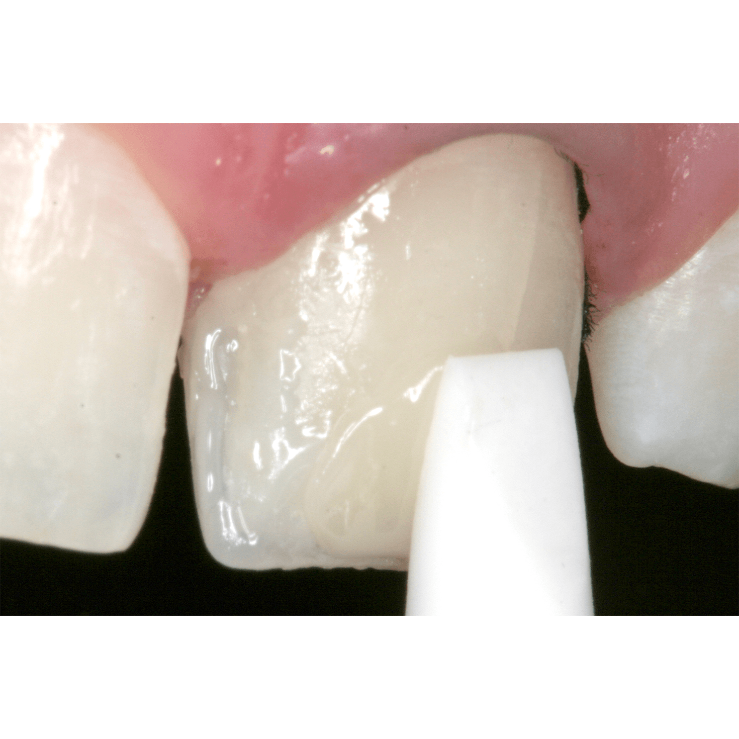 قلم سیلیکونی فرم دهنده کامپوزیت Esthetic Plus